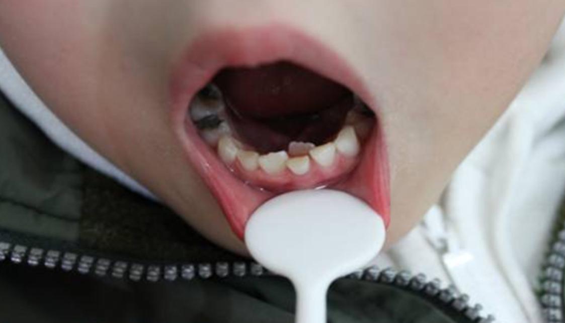 6歲女童吃得太精細長出雙排牙
